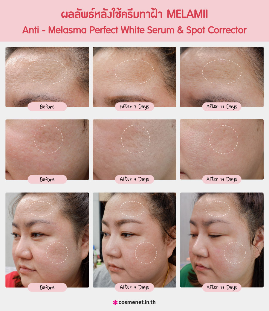 รีวิว ครีมทาฝ้า Melamii Anti-Melasma Perfect White Serum & Spot Corrector