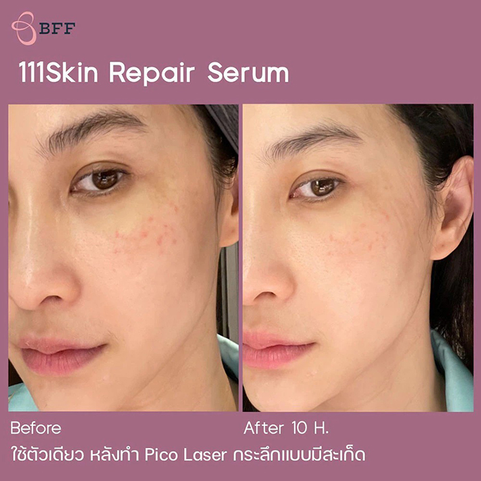 เซรั่มบำรุงผิวหน้า 111SKIN Repair Serum NAC Y²™