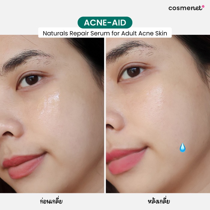 เซรั่มบำรุงผิวหน้า Acne-Aid Naturals Repair Serum For Adult Acne Skin