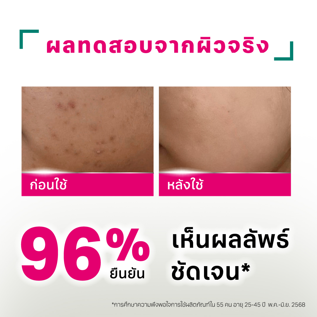 มอยซ์เจอร์ไรเซอร์ Acne-Aid Naturals Adult Acne Soothing Moisturiser