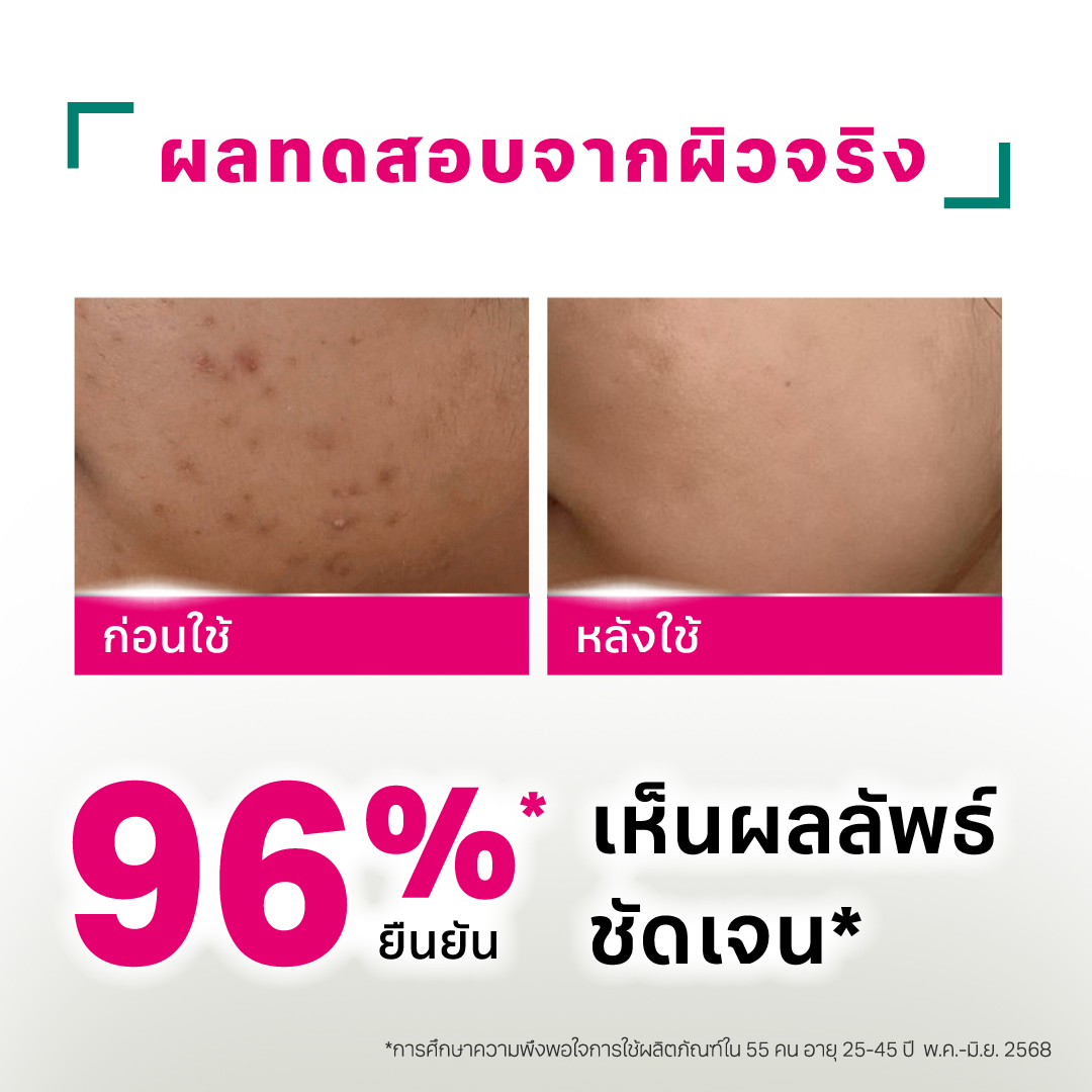 เซรั่มบำรุงผิวหน้า Acne-Aid Naturals Repair Serum For Adult Acne Skin