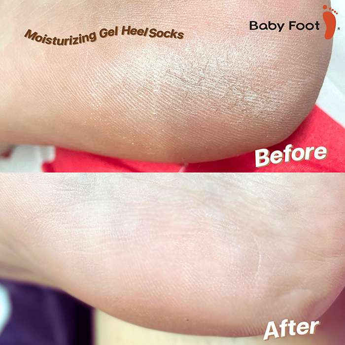 ชุดถุงเท้าพร้อมครีมบำรุงส้นเท้าแตกและแห้งกร้าน Baby Foot Heel Crack Prevention Set x Kuromi