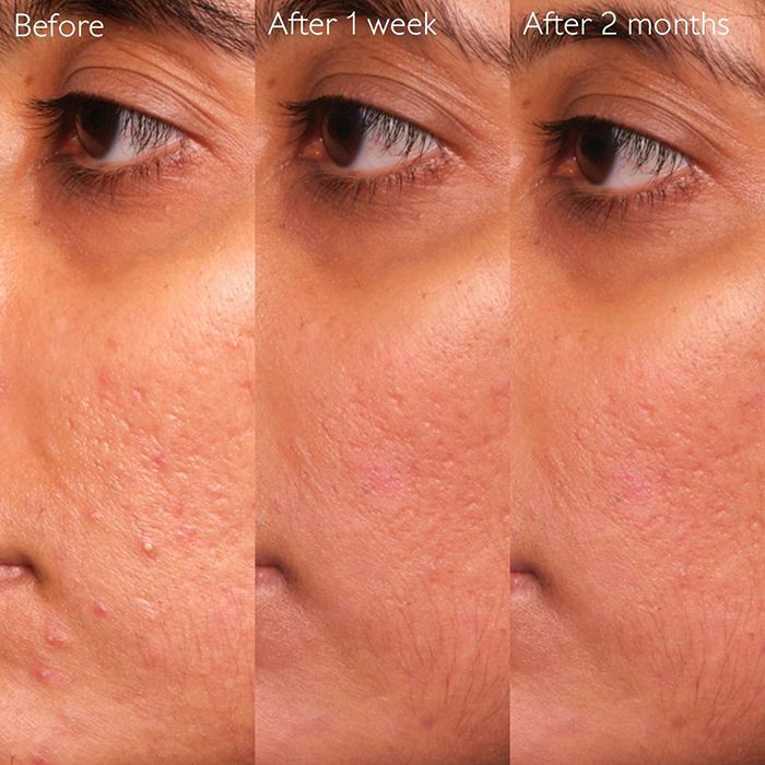 เซรั่ม Caudalie Vinopure Blemish Control Infusion Serum