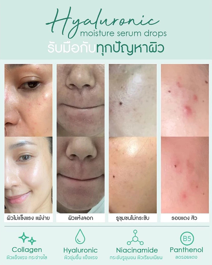 เซรั่ม Cho Skin Hyaluronic Moisture Serum Drops