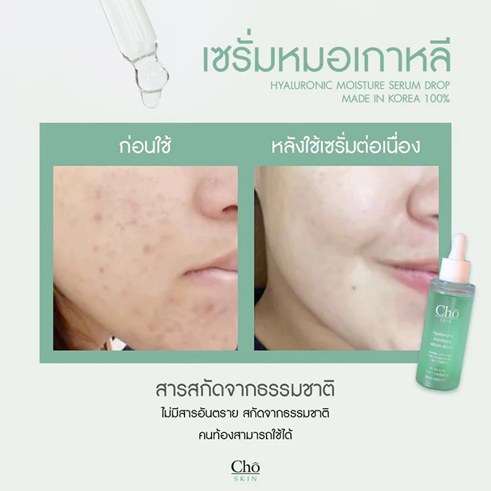 เซรั่ม Cho Skin Hyaluronic Moisture Serum Drops