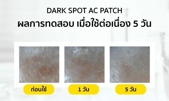 แผ่นแปะสิว ลดรอยสิว Curesys Dark Spot AC Needle Patch