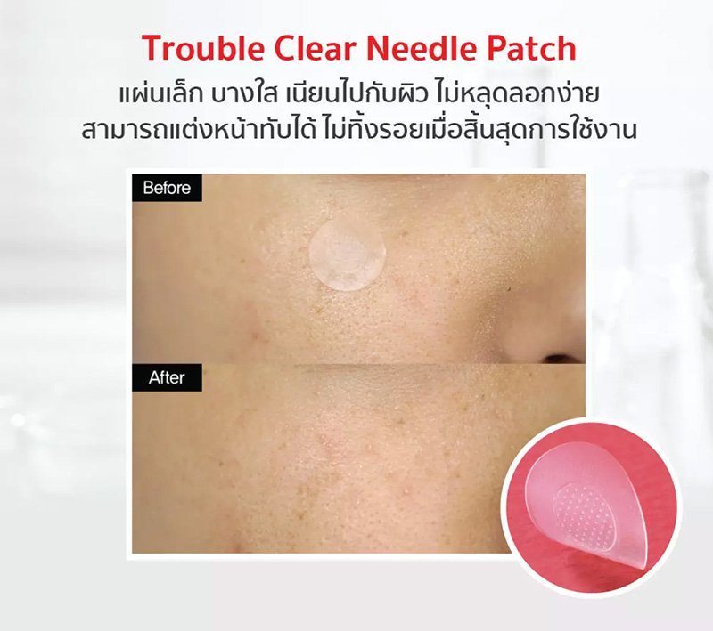 แผ่นแปะสิว หัวเข็ม Curesys Trouble Clear Needle Patch