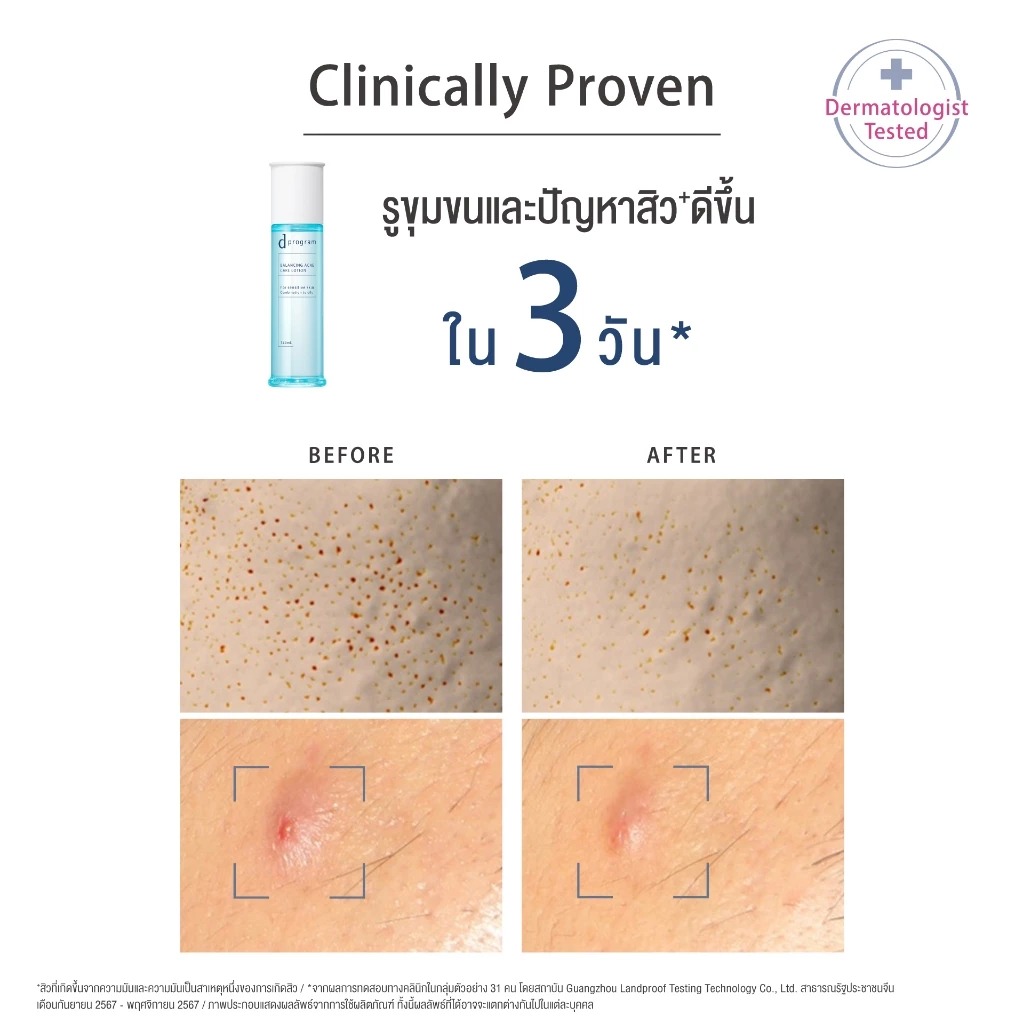 อิมัลชั่น d Program Balancing Acne Care Emulsion อิมัลชั่น d Program Balancing Acne Care Emulsion