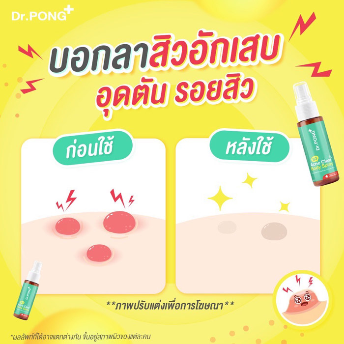 Dr. PONG B3 Acne Clear Body Spray สเปรย์สำหรับผิวกาย 