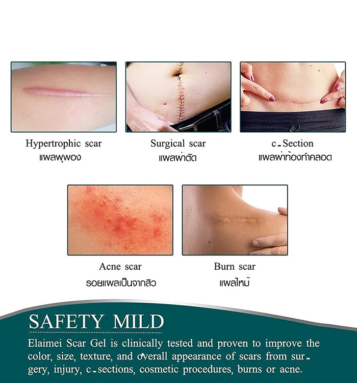แผ่นแปะซิลิโคนลดรอยแผลเป็นนูน ELAIMEI Silicone Scar Sheets