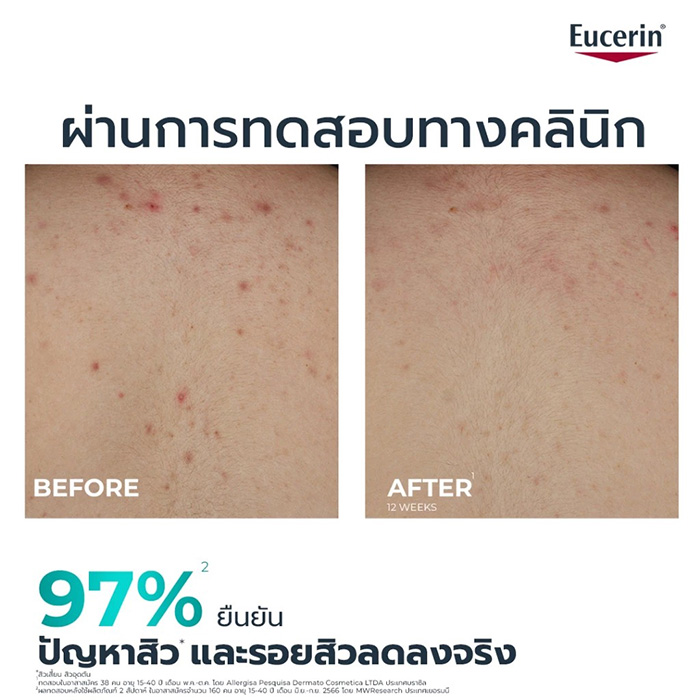 โลชั่นลดสิว Eucerin Dermopure Clinical Correcting Body Care