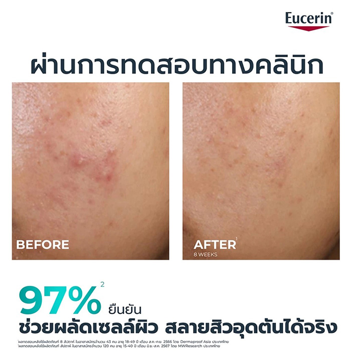 ทรีตเมนต์ Eucerin Dermopure Clinical Peeling 10