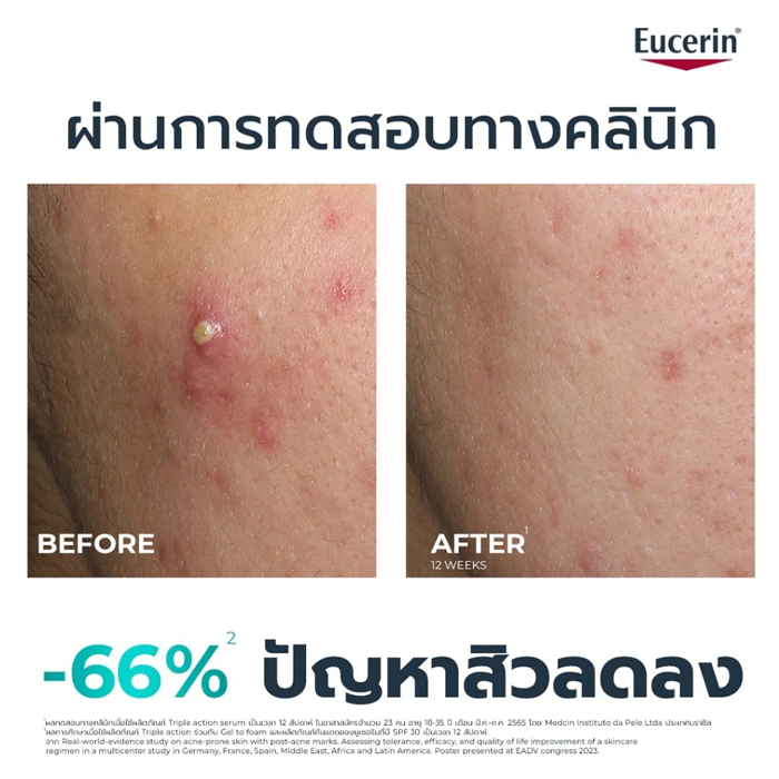 เซรั่มจัดการปัญหาสิวและรอยสิว Eucerin Dermopure Clinical Triple Action เซรั่มจัดการปัญหาสิวและรอยสิว Eucerin Dermopure Clinical Triple Action