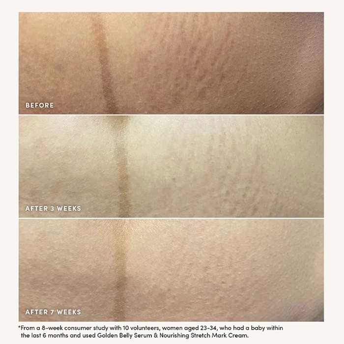 ครีมบำรุงผิวเพื่อป้องกันรอยแตกลาย Evereden Nourishing Stretch Mark Cream