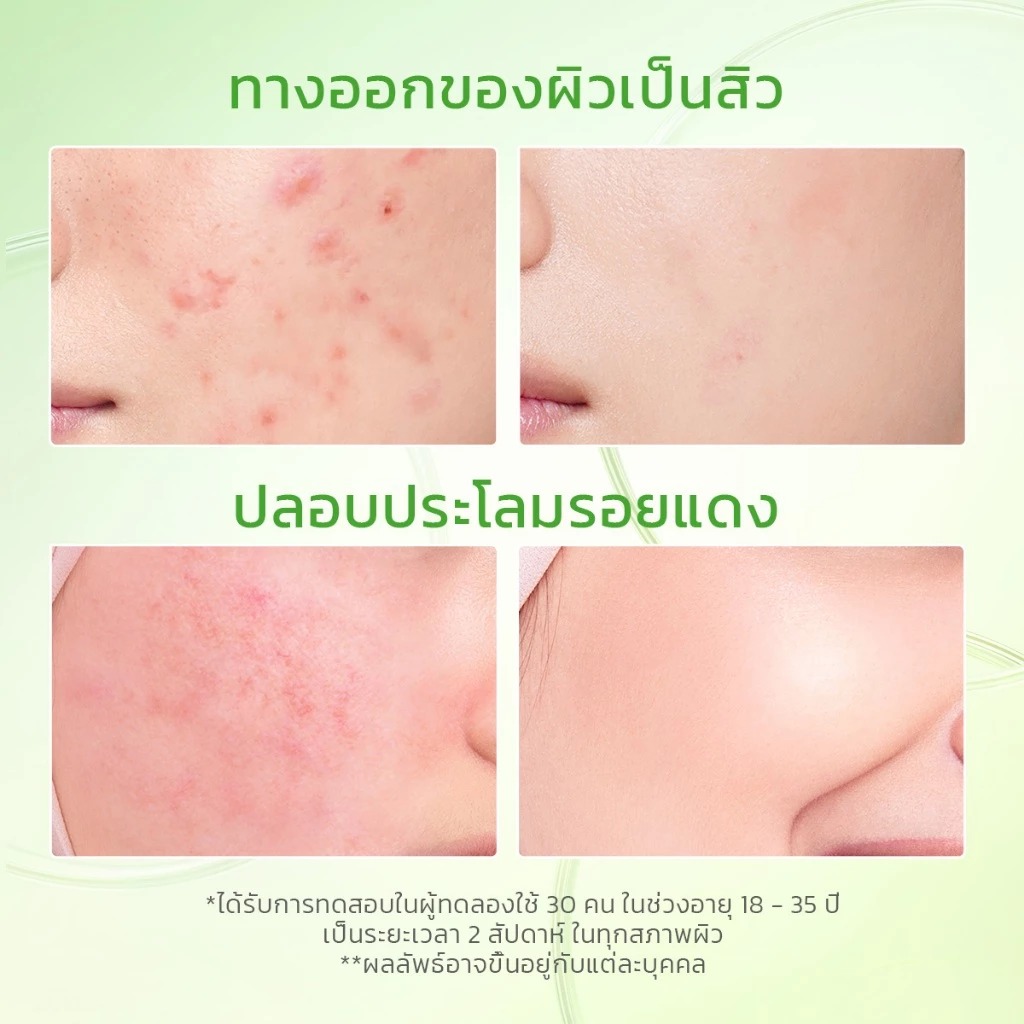 มอยเจอไรเซอร์ต้านสิว Glad2Glow Kiwi 3D Acid Acne Moisturizer