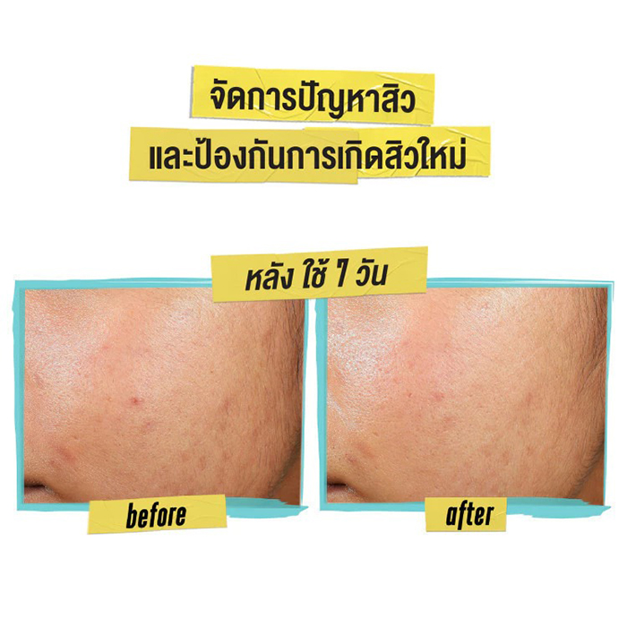 โลชั่นเจล Kiehl's Expertly Clear Blemish-Treating & Preventing Lotion