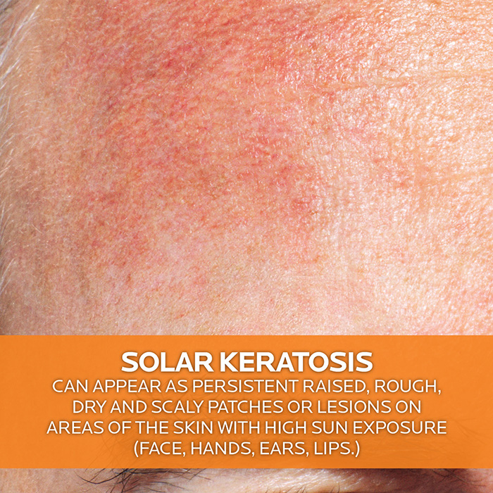 ครีมกันแดด La Roche-Posay Anthelios 100 KA+ Cream SPF50+