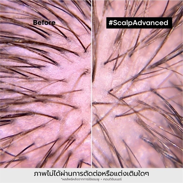 ทรีทเมนท์บำรุงผมและหนังศีรษะ L'OREAL PARIS Professionnel New Serie Expert Scalp Advanced Anti-Discomfort Treatment