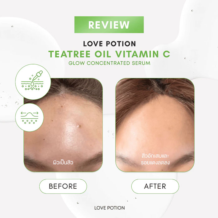 เซรั่ม Lovepotion Teatree Oil Vitamin C Glow Serum