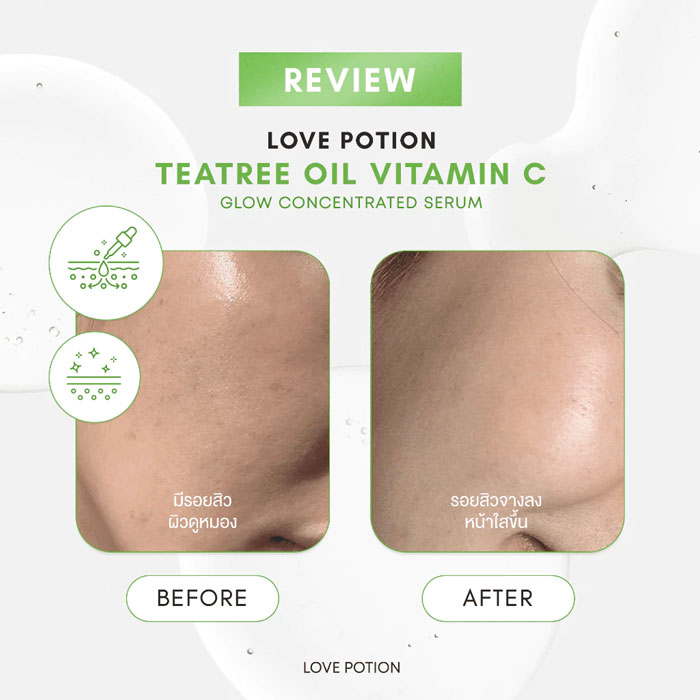 เซรั่ม Lovepotion Teatree Oil Vitamin C Glow Serum