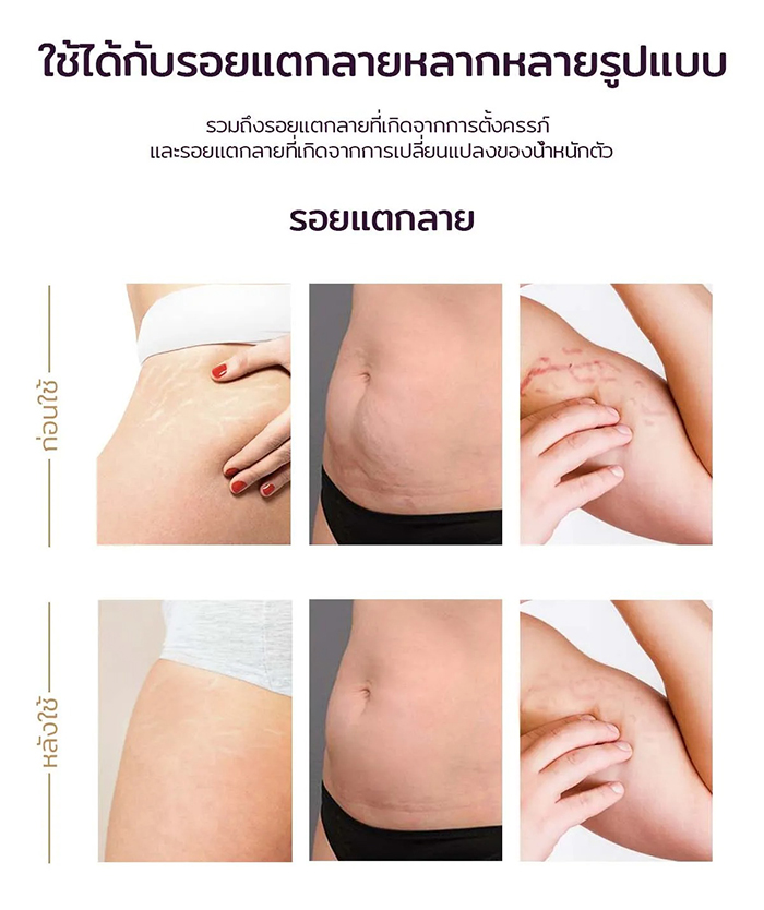 ครีมบำรุงผิวเพื่อป้องกันรอยแตกลาย Mederma  Stretch Marks