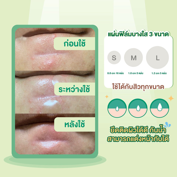 แผ่นปิดดูดซับของเหลว Mentholatum Acnes Dressing (Sterile)