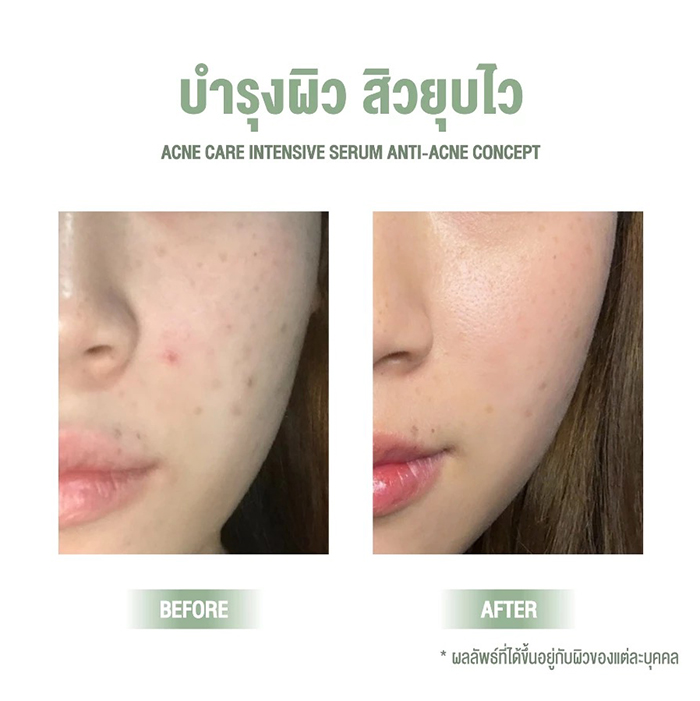 เซรั่ม Nakiz Lively Nose Acne Care Intensive Serum