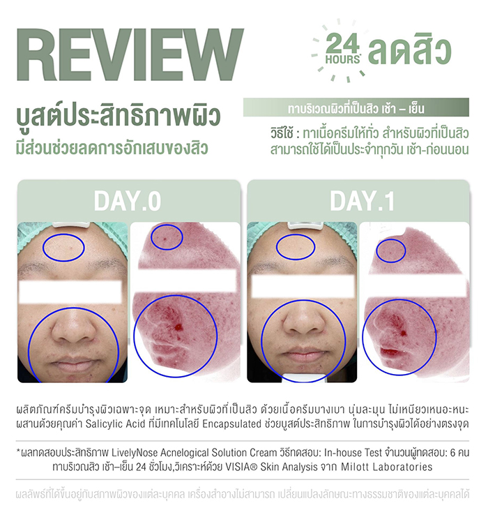 เจลแต้มสิว Nakiz Lively Nose Acnelogial Solution Cream