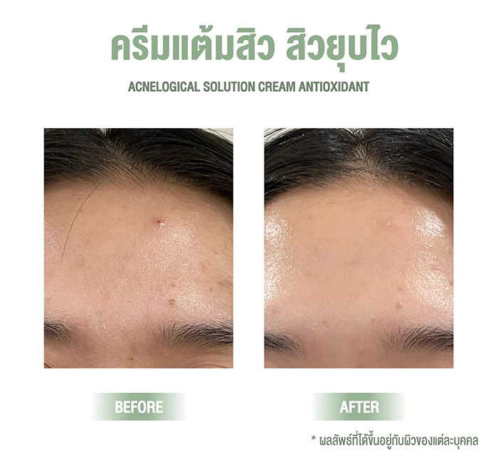 เจลแต้มสิว Nakiz Lively Nose Acnelogial Solution Cream