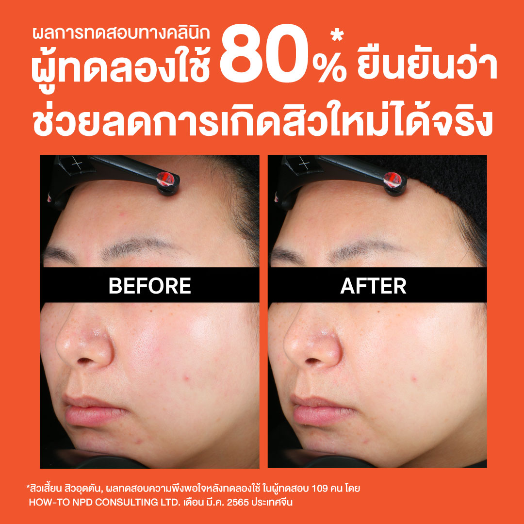 โฟมล้างหน้า Neutrogena Deep Clean Acne Foaming Cleanser