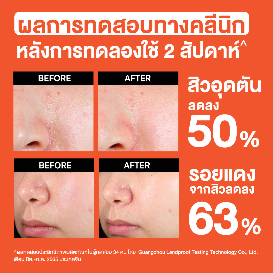 โฟมล้างหน้า Neutrogena Deep Clean Acne Foaming Cleanser