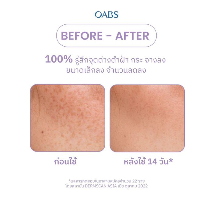 เซรั่มลดฝ้า กระ จุดด่างดำ OABS Anti Melasma Spotless Brightening Booster Serum เซรั่มลดฝ้า กระ จุดด่างดำ OABS Anti Melasma Spotless Brightening Booster Serum