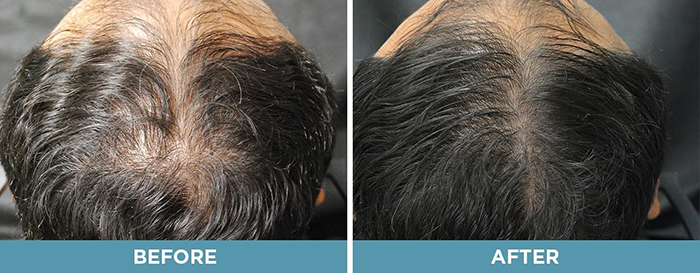 เซรั่มบำรุงหนังศีรษะ PHYTO Cyane-Men Anti-Hair Loss for Men