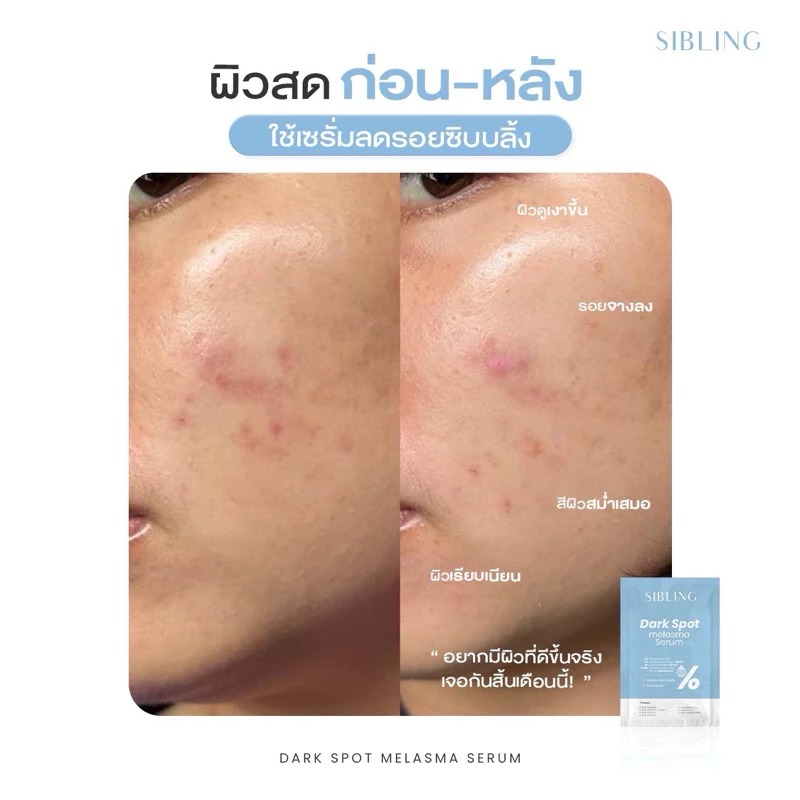 เซรั่ม Sibling Dark Spot Melasma Serum