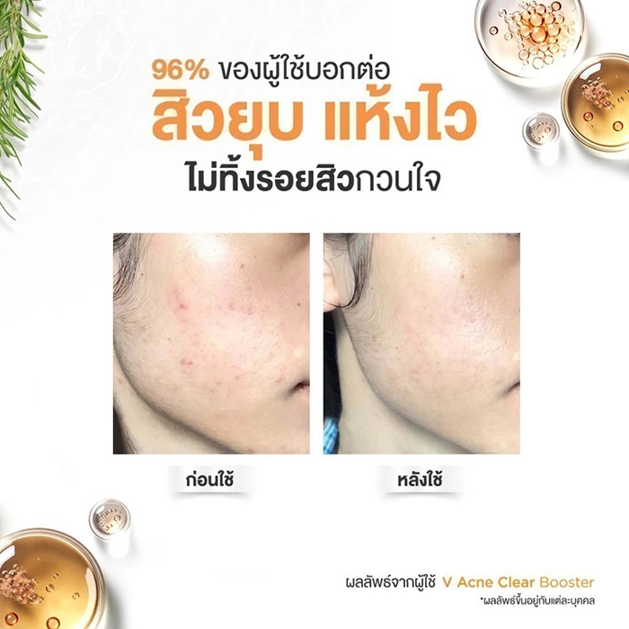 เซรั่มบำรุงผิวหน้า Skinsista V Clear Booster For Men