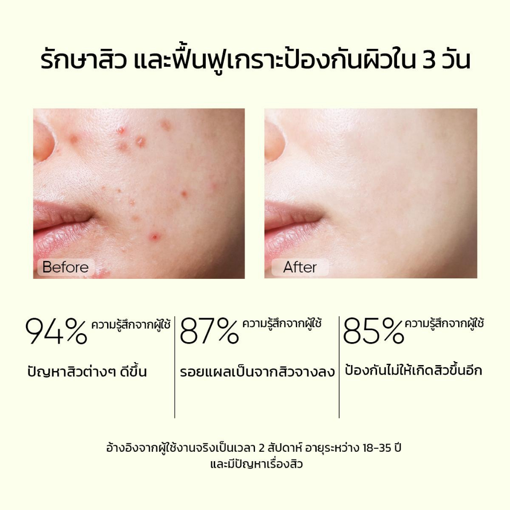 SKINTIFIC 2% salicylic acid Acid Anti Acne Serum