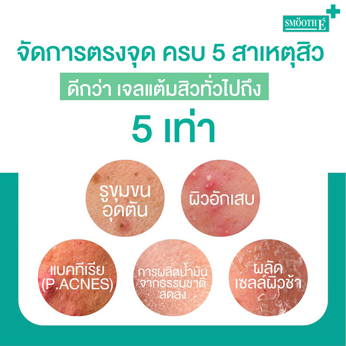 เจลแต้มสิว Smooth E Acne-5 Rapid Action Plus เจลแต้มสิว Smooth E Acne-5 Rapid Action Plus
