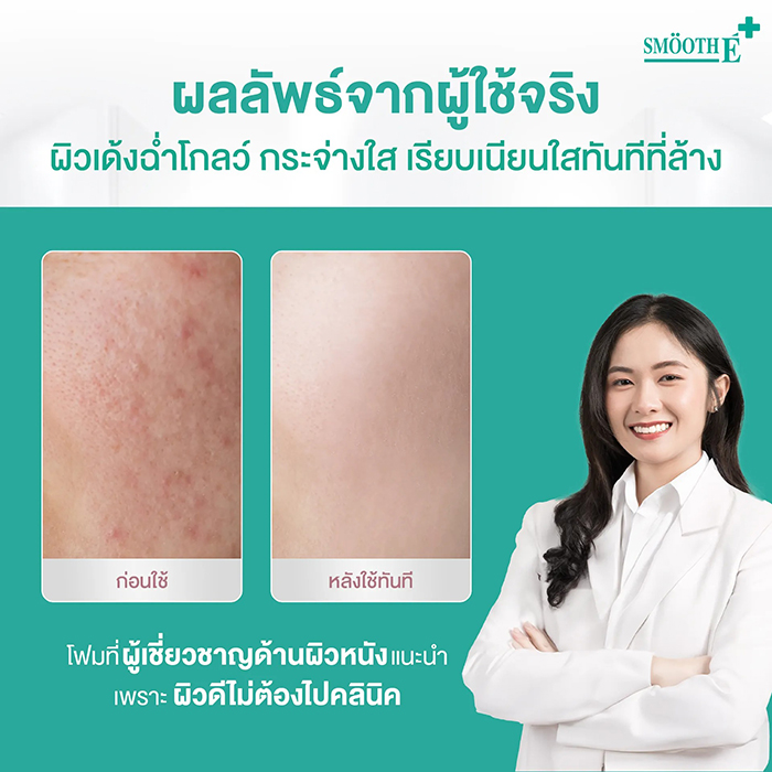 โฟมล้างหน้า Smooth E White Babyface Spotclear