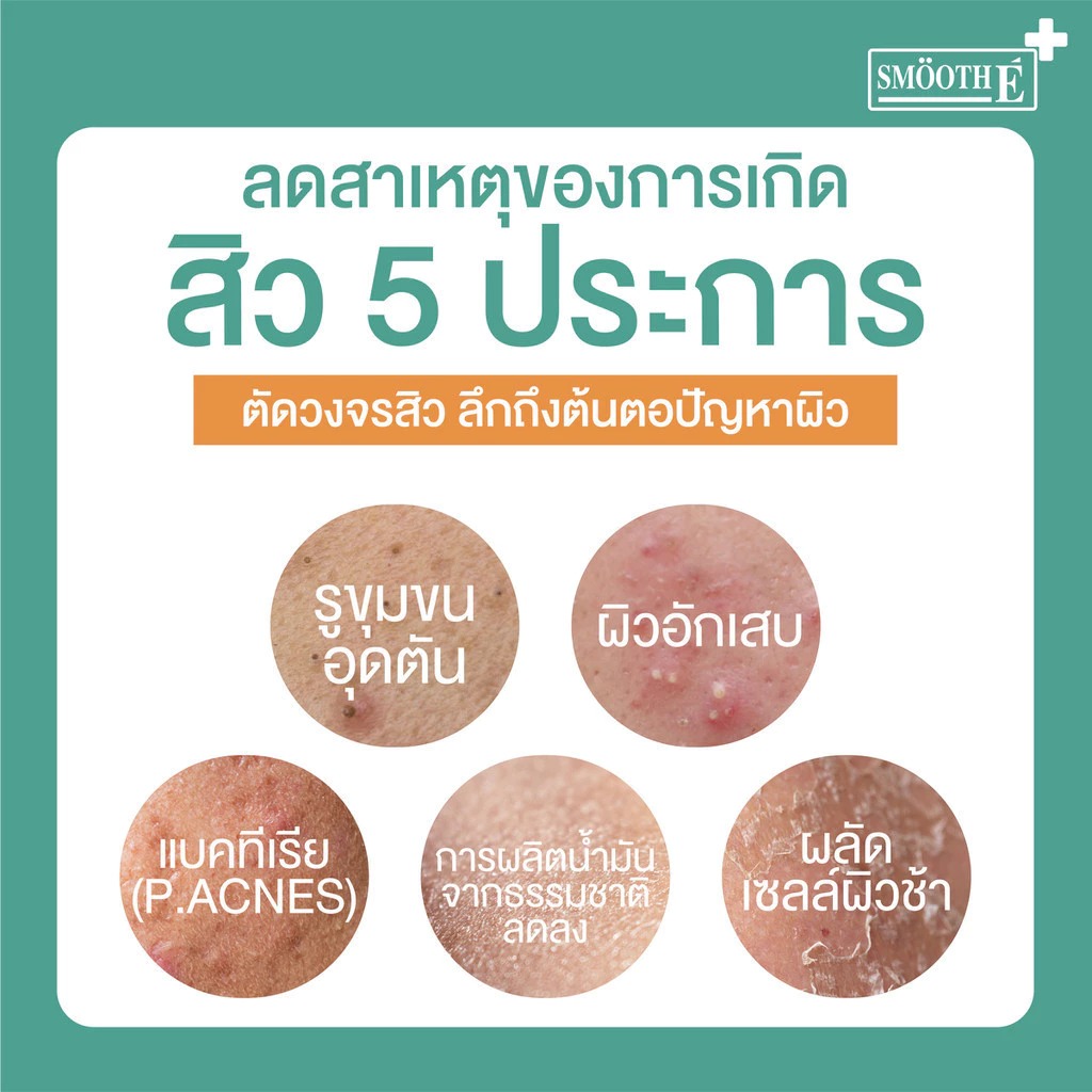 เซรั่มคุมสิว Smooth E Acne-5 Spot Pore Serum