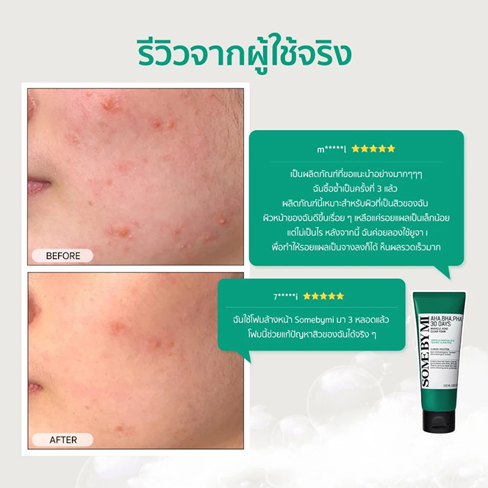 โฟมล้างหน้า SOME BY MI AHA-BHA-PHA 30Days Miracle Acne Clear Foam