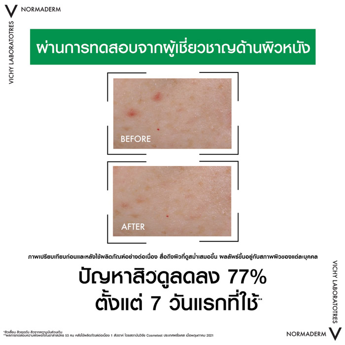 Vichy Normaderm Pro-Bio BHA Serum เซรั่ม ลดสิวเสี้ยน สิวอุดตัน สิวจากความมันส่วนเกิน 