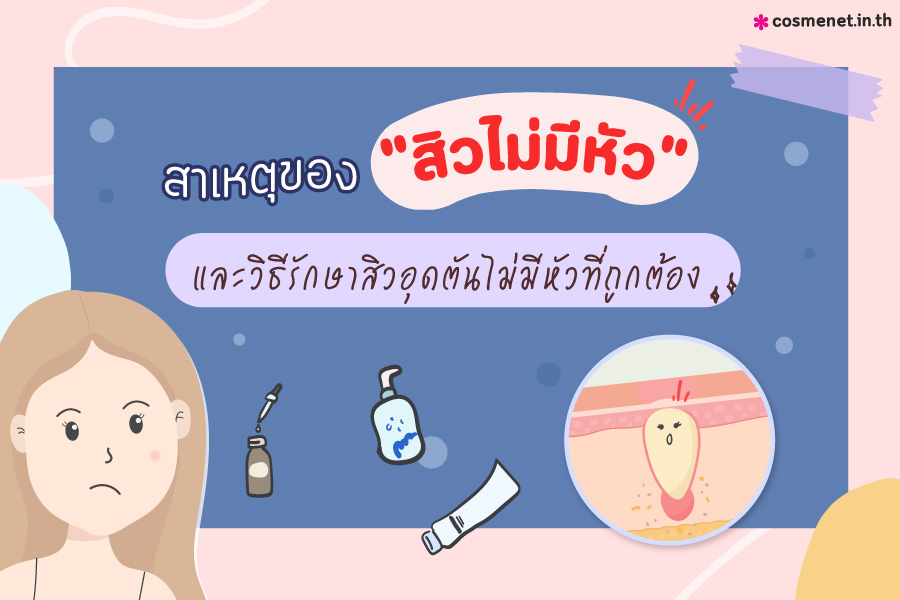 สิวไม่มีหัว เกิดจากอะไร วิธีรักษาสิวอุดตันไม่มีหัว