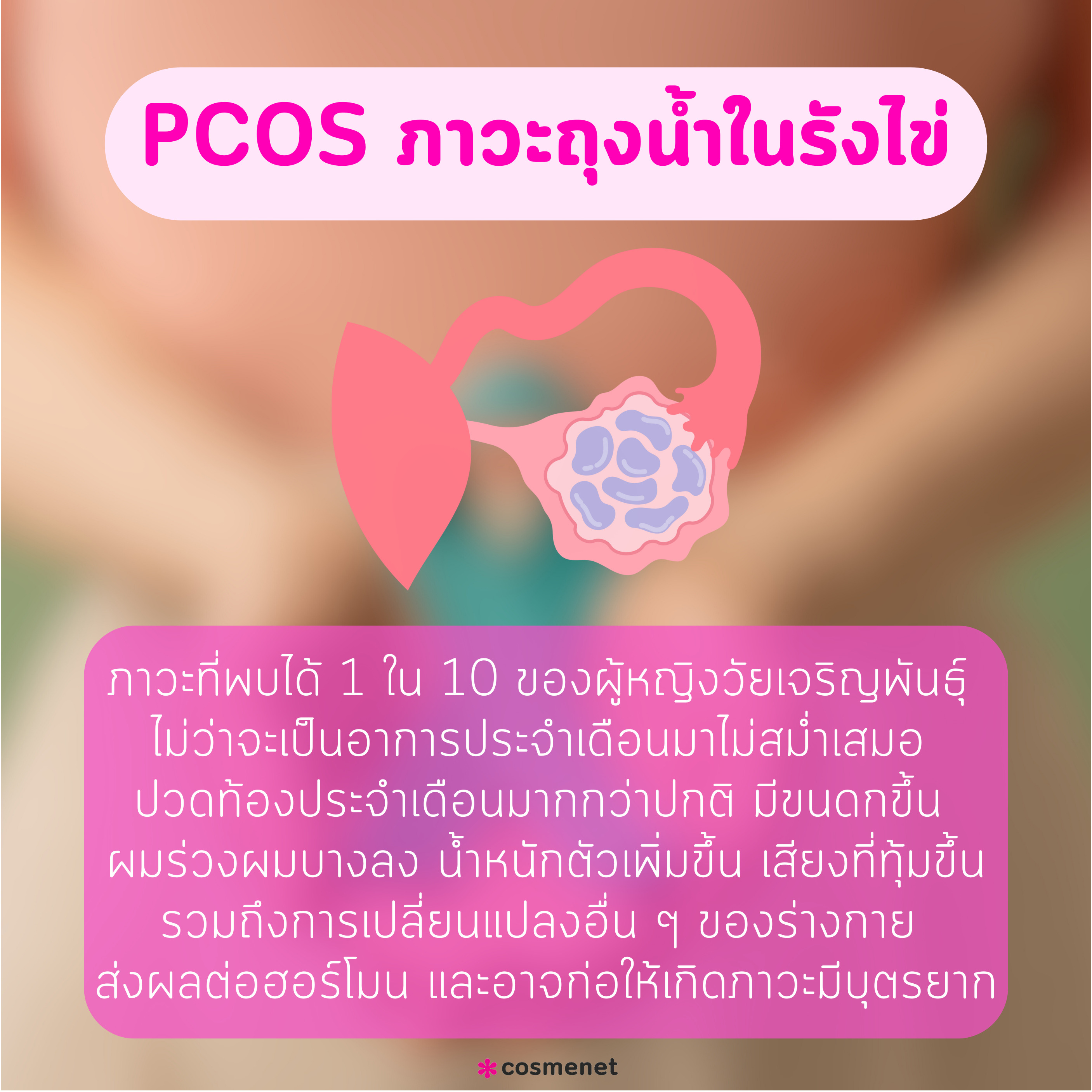 PCOS ภาวะถุงน้ำในรังไข่ อาการยอดฮิตของสาว ๆ วัยทำงาน