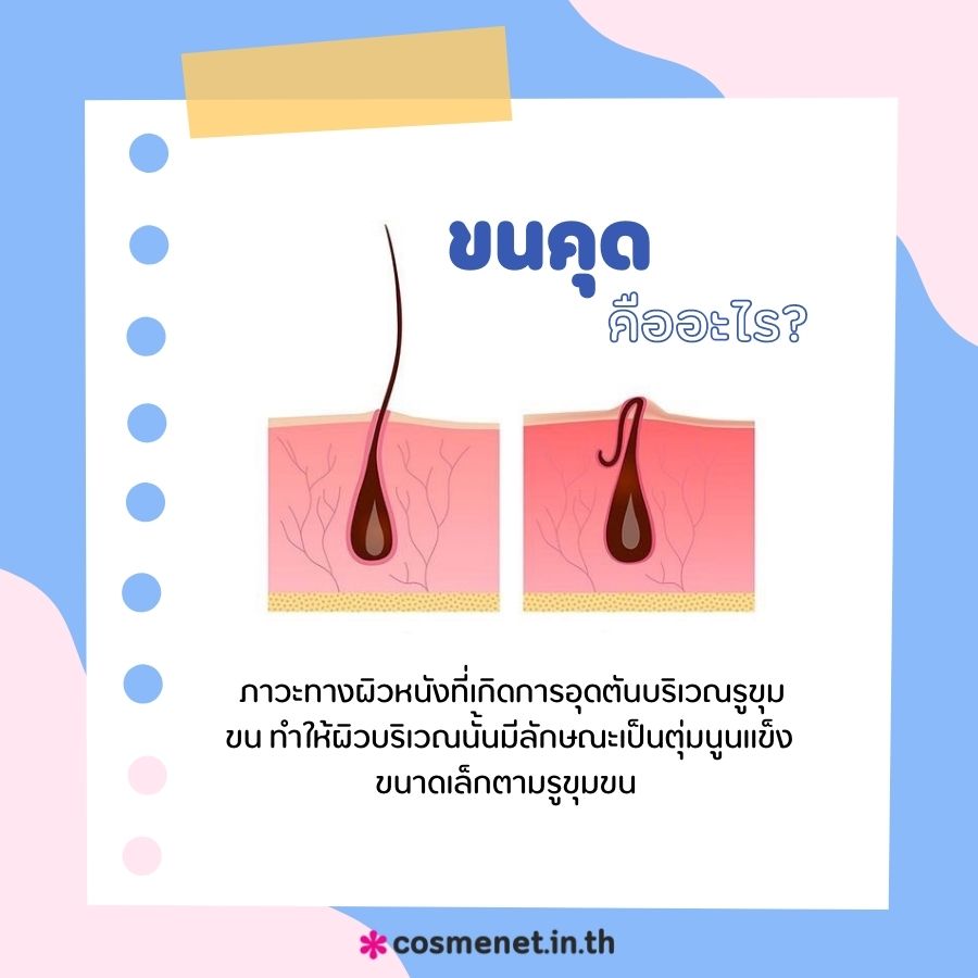 ขนคุดคืออะไร 