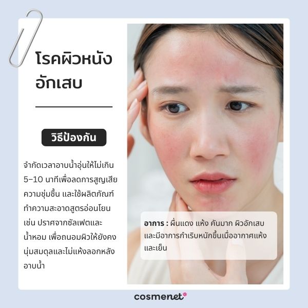 โรคผิวหนังอักเสบ