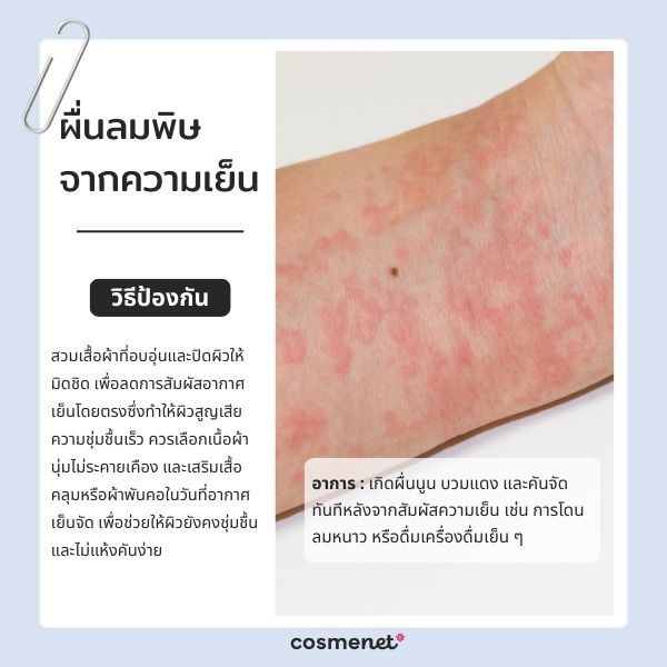 ผื่นลมพิษจากความเย็น