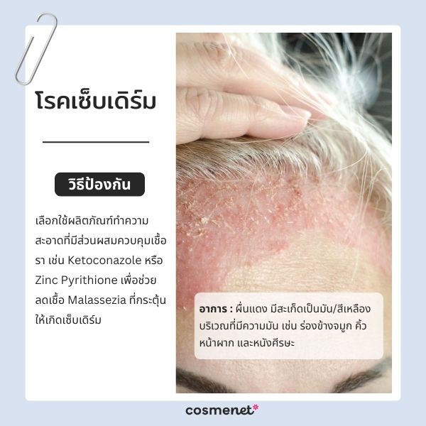 โรคเซ็บเดิร์ม