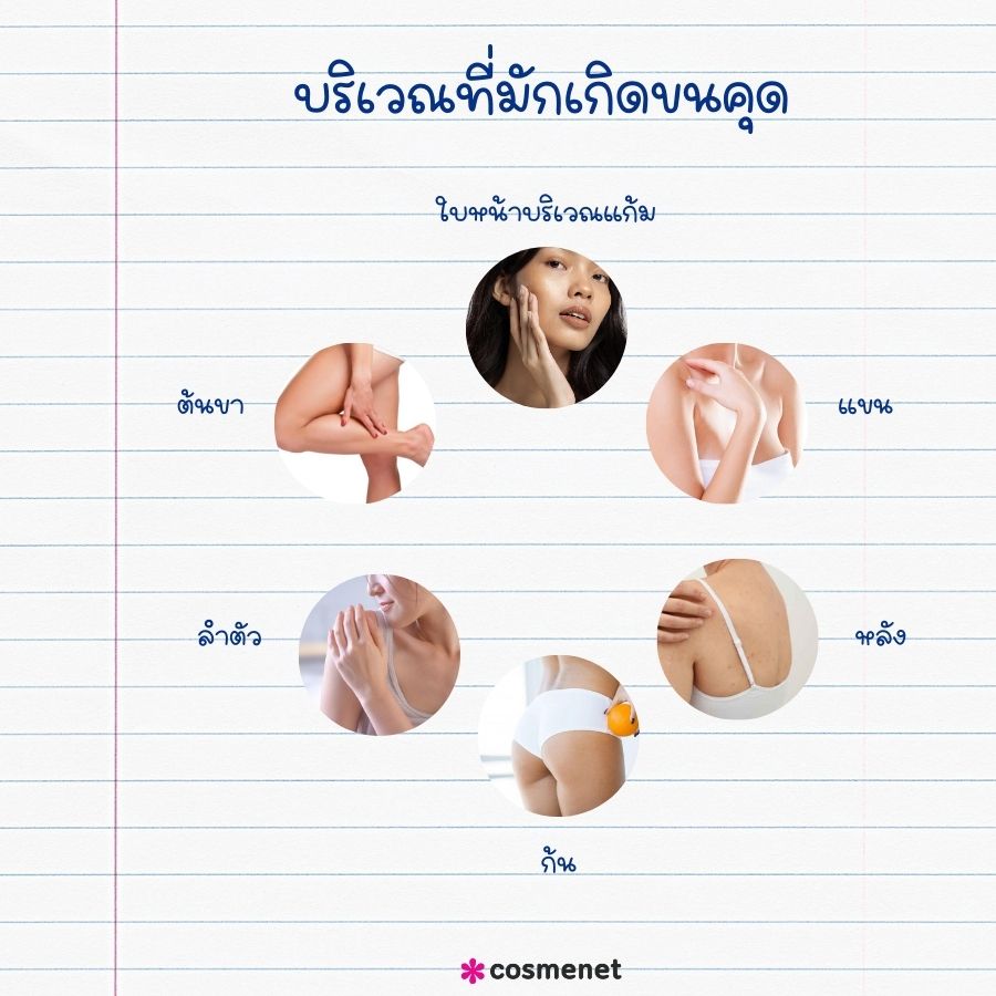 บริเวณที่มักเกิดขนคุด