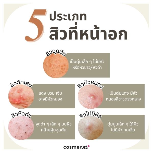 5 ประเภทสิวที่หน้าอก