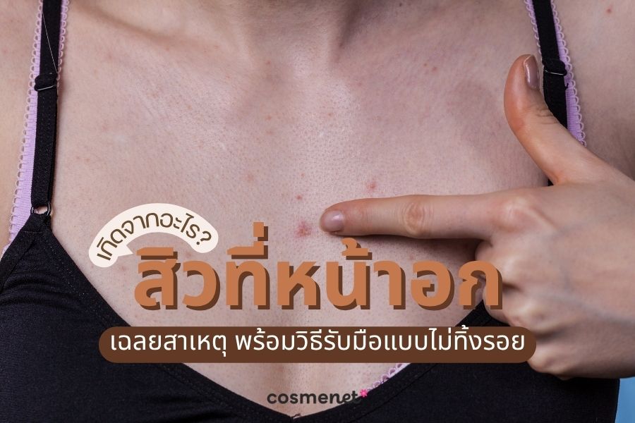 สิวที่หน้าอก เกิดจากอะไร